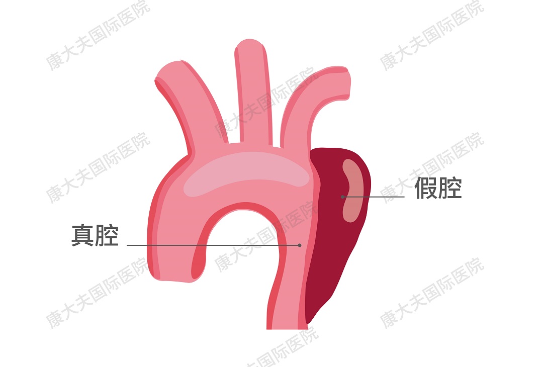 "主动脉夹层指的是,在血流的不断冲刷下,内膜层出现了撕裂,血液钻到
